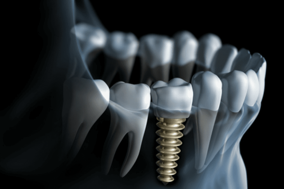 Todo lo que debe saber sobre los implantes dentales
