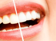 Métodos naturales para blanquear los dientes