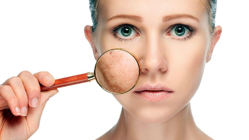 Alimentos que pueden producir acné